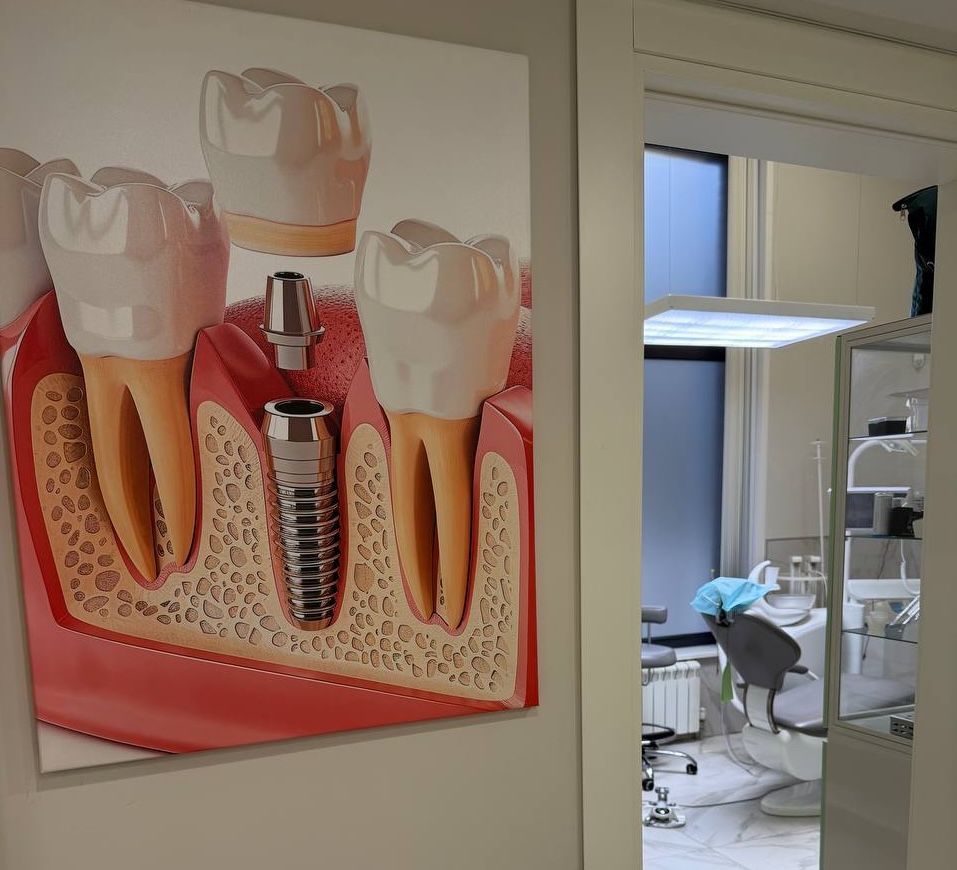 Установка имплантанта 85.000 р.