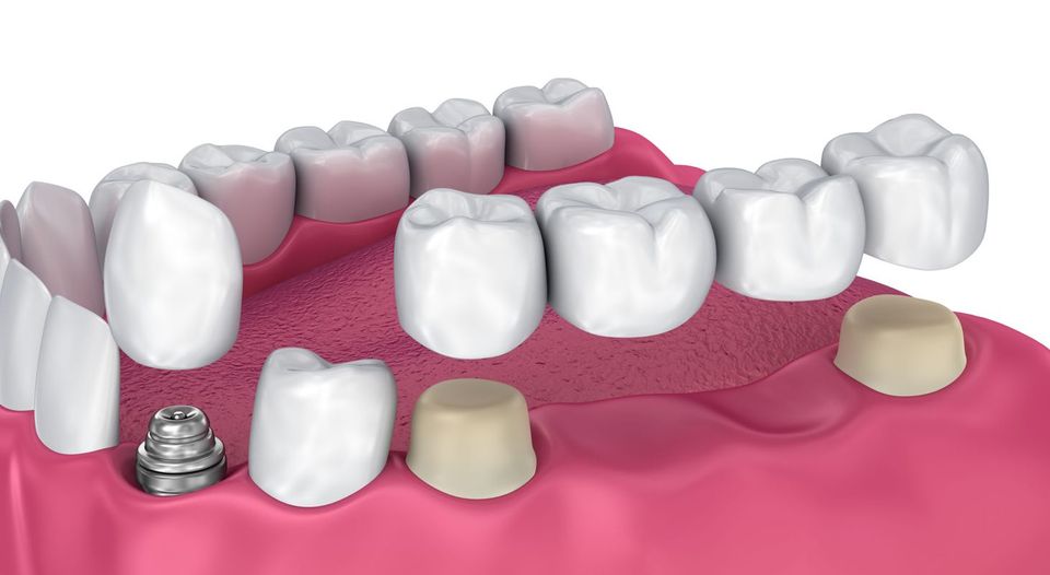 Несъемное протезирование